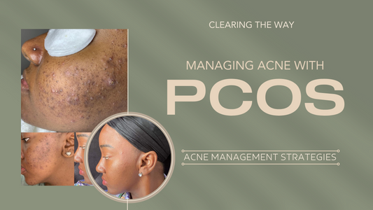 Managing Acne With PCOS