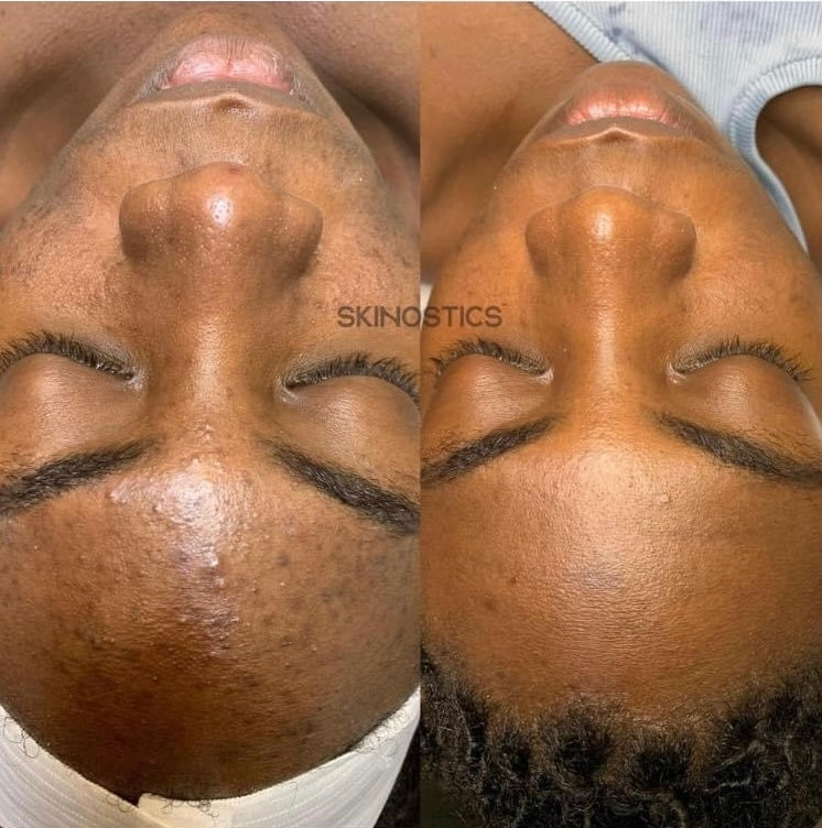 Blemished To Brighten Kit