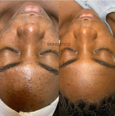 Blemished To Brighten Kit