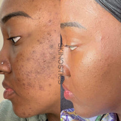 Blemished To Brighten Kit